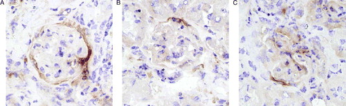 Figure 1.  Immunohistochemical staining patterns of fractalkine. (A) ring formation, (B) surface coverage <30% and (C) surface coverage >30%.