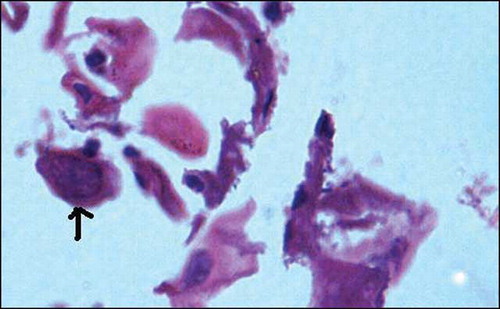 Figure 1.  Photomicrograph showing exfoliated esophageal squamous epithelial cells with herpes simplex nuclear inclusions (arrow), hematoxylin eosin stain, 400×.