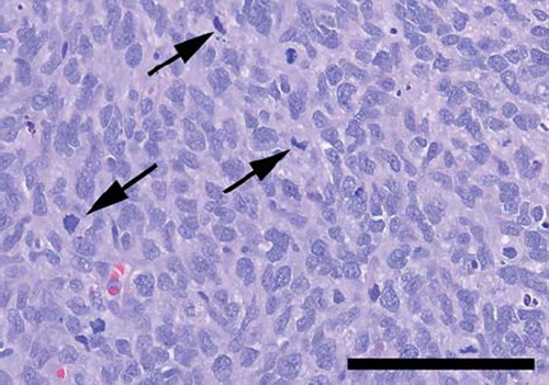 Figure 2. Highly cellular tumour tissue, displaying nuclear polymorphism and mitoses (arrows) (Haematoxylin-eosin. Bar: 100 μm).