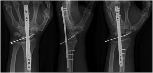 Figure 2. Left wrist status post DSP, headless compression screw, and single pin fixation.