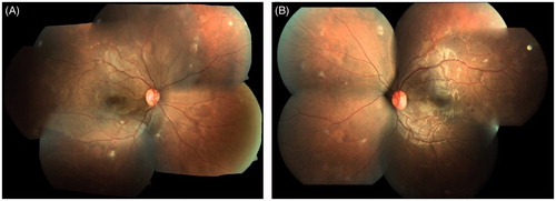 Figure 1. Fundus photographs showing well-demarcated area of retinal whitening in the posterior pole with multiple cotton wool spots in both eyes and retinal hemorrhage in the left eye.