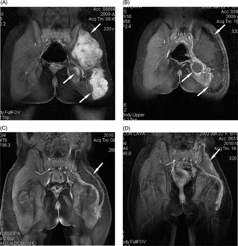 Figure 1. A 7-year-old girl with multiple recurrent desmoid tumour nodules in the left leg and buttock, who received three surgical resections before HIFU ablation. Further resection was considered impossible. HIFU ablation was performed with a palliative aim. (A) Before HIFU ablation, there were multiple tumour nodules (arrows) which showed high enhancement on coronal T1-weighted contrast-enhanced MRI. (B) One month after HIFU ablation, almost all treated tumours (arrows) showed no enhancement. (C) Nine months after HIFU ablation, the treated area (arrow) showed no enhancement and shrank significantly. (D) Sixteen months after HIFU ablation, the treated area (arrow) showed no enhancement and shrank further.