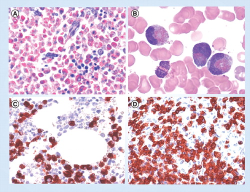 Figure 2. Hypereosinophilia assessed by microscopy.(A) Giemsa-stained bone marrow section in a patient with eosinophilic leukemia. Note the massive eosinophil infiltrate replacing the normal bone marrow. (B) Circulating immature eosinophils in a patient with FIP1L1/PDGFRA+ chronic eosinophilic leukemia. (C) & (D) Bone marrow biopsy sections obtained from a patient with FIP1L1/PDGFRA+ chronic eosinophilic leukemia. Sections were incubated with an antibody directed against eosinophil major basic protein and analyzed by indirect immunohistochemistry.