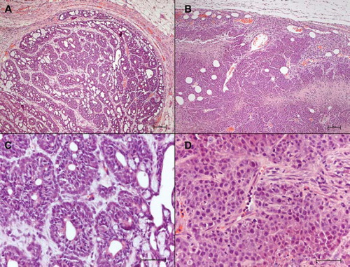 Figure 1. Histopathology of DMBA and MAT B III tumors. Paraffin sections stained with hematoxylin/eosin. Bars: A and B 100 μm; C and D 50 μm. A. Light micrograph showing a DMBA tumor. Cords of tumor cells form gland-like structures, which are separated by strands of dense connective tissue. Note the distinct, thick capsule. Htx/E. B. Light micrograph of a MAT B III tumor, showing low differentiation of the densely packed tumor cells, absence of organized structures, scanty extracellular matrix and irregular infiltration by tumor cells in the surrounding connective tissue. C. Higher magnification of a DMBA tumor, showing the differentiated glandular appearance of the tumor. D. Higher magnification of a MAT B III tumor, showing the densely packed pleomorphic tumor cells. Occasional mitotic figures are seen.