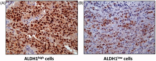 Figure 4. Immunostaining of tumour tissues showing highly phosphorylated HSF-1 in ALDH1-high tumour cells. Xenograft tumours were obtained by transplantation of ALDH1-high population (A) and ALDH1-low population (B) of HEC-1 cells into NOD/SCID mice. The formalin-fixed tumour tissue sections were stained with anti-phospho-HSF1 (S326) antibody (abcam, Cambridge, UK). Higher nuclear staining in the ALDH-high tumour tissue (A) indicates that HSF1 could be activated in the cells [Citation60].