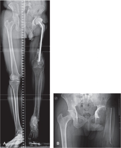 Figure 1. A. Before the turn-up plasty: 24-cm circumferential femoral bone loss and a moderate acetabular bone defect, with a 13-cm shortening of the left leg, a homolateral knee with 15 degrees of fixed flexion, and a fixed equinus deformation of the ankle. B. At 2-year follow-up.