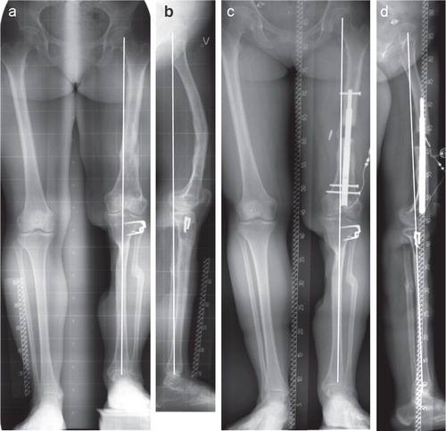Figure 6. A patient in the nail group (pair 15) with postraumatic deformity including shortening and procurvatum.