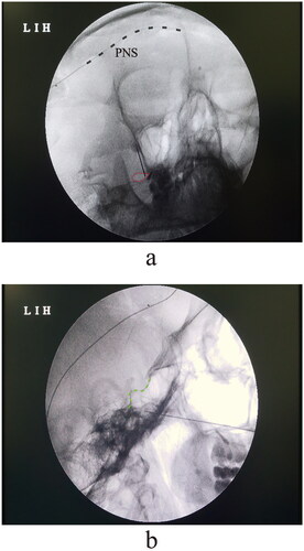Figure 1. Surgical schematic of PNS implantation and PRF placement. (a) Anteroposterior view of fluoroscopic imaging. Red cycle indicated the foramen ovale; blue line indicated the mandibula; (b) depth of PRF cannulation was guided under the lateral view of the fluoroscopy.