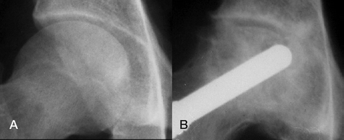 Figure 4. 27-year-old man with osteonecrosis secondary to cortisone intake for Hodgkin lymphoma. A. Preoperatively, the disease was clas-sified as Steinberg stage II. B. 3 years later, the hip had deteriorated radiographically to Steinberg stage VI and required revision to THA.