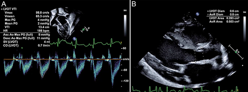 Figure 6 Potential measurement errors with LVO. Small changes in probe placement, angle of insonation, and cursor position lead to large changes in cardiac output estimations. (A) Measurement of LVOT velocity time integral. (B) Measurement of LVOT and aortic root diameter.