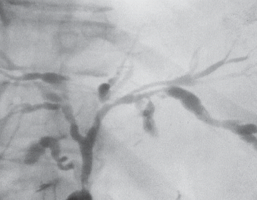 Figure 6. Primary sclerosing cholangitis visualized by endoscopic retrograde cholangiopancreatography (ERCP).
