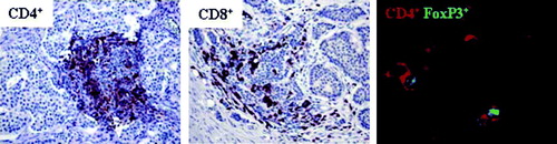 Figure 5.  Midgut carcinoids demonstrate lymphocyte infiltration including FoxP3+ cells. Presence of tumor infiltrating lymphocytes was detected by immunohistochemistry (n=10) and immunofluorescence microscopy (n=10). Inflammatory foci with CD4+ and CD8+ cells in the tumor area are shown at 20x magnification. A representative immunofluorescent staining of FoxP3+-expressing CD4+ cells, with CD4+ indicated by red and FoxP3+ by green, is also shown.