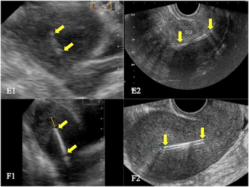 Figure 5. Ultrasonographic images. E - hormonal IUD identified as entirely within the uterine cavity by POCUS (E1) and the same IUD with a small portion within the cervical canal identified by conventional US (E2); F - a small part of a copper IUD apparently within the cervical canal found by POCUS (F1) and the same IUD entirely within the uterine cavity by conventional US (F2). The top and the distal end of the IUDs are indicated by yellow arrows. In the image F1, the proximal portion of the string was probably mistaken for the end of the IUD.