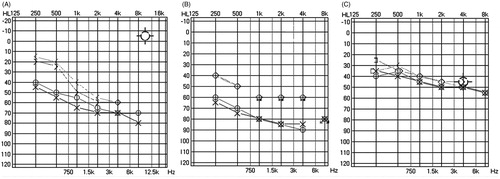 Figure 3. Audiograms of patients III-2 and IV-2. (A) Audiogram of patient III-2 at age of 5 years. (B) Audiogram of patient III-2 at age of 8 years. (C) Audiogram of patient IV-2 at age 5 years. Bilateral air–bone gaps are recognized, especially at lower frequencies in patient III-2. Circle or × indicate unmasked examination of air conduction for the right or left ear, triangle or square indicate masked examination of air conduction for right or left ear, < or > indicate unmasked bone conduction for right or left ear, [ or ] indicate masked bone conduction for right or left ear.