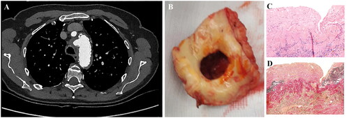 Figure 1. Illustrations of pre-operative imaging findings with corresponding macroscopic aspect of mycotic aortic aneurysms (‘typical’ coin-sized lesions of the inner aortic wall) and representative histopathological images of a mycotic aorta specimen. (A) Transverse CTA image with saccular aneurysm (aortic arch level) and (B) shows the resected part with typical coin-sized hole in the aortic wall. (C) H&E-stained section shows transmural acute inflammation, in addition to atherosclerotic changes; and (D) Elastica van Gieson staining demonstrates the medial disruption. CTA: computed tomography angiography.