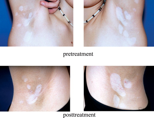 Figure 12. Vitiligo. Local loss of skin pigmentation due to the malfunction or loss of melanocytes. After three months' treatment with tacrolimus, the size of lesions is decreased.