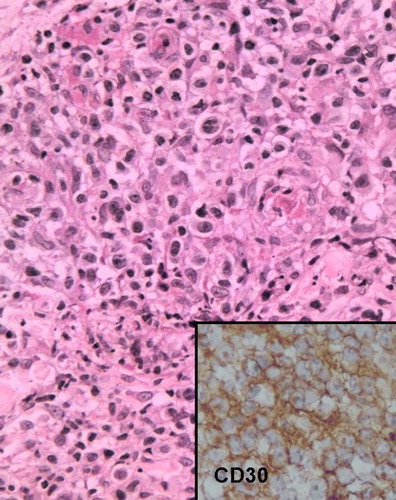 Figure 4.  Anaplastic largecell lymphoma pattern. Large lymphoid cells with abundant and eosinophilic cytoplasm and anaplastic nuclei (HE, ×200). Insert: CD30+ cells (×200).