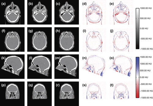 Figure 3. CT images (a,f,k,p), CT substitutes derived from a model including spatial variables (b,g,l,q), CT substitutes derived from a model without spatial variables (c,h,m,r) and difference between CT substitute and CT for the model with (d,I,n,s) and without (e,j,o,t) spatial information.