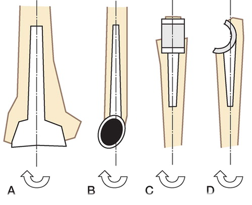 Figure 2. Schematics used to determine the malalignment of the components. A–D: ideal alignment of the components; the axis of the component is parallel to the defined axis of the humerus and ulna, respectively. Deviation from the axis in valgus-varus and flexion-extension was measured in degrees (arrow).