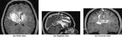 Figure 2. 3D composite ultrasound volume: MRI in grey with US overlaid in a hot-metal color scale. (a) axial view; (b) sagittal view; (c) coronal view.