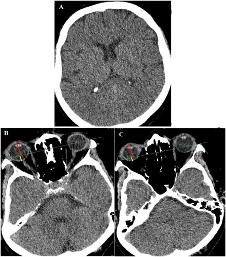 Figure 1. Brain CT Scan (A) No pathological inter- and extra-axial findings that could explain the patient’s neuro-ophthalmological symptoms were observed in the axial CT scan images of the brain. (B and C) Evidence of proptosis was found in the right orbit. Proptosis is diagnosed in cross-sectional images by measuring the distance between the anterior and posterior edges of the globe to the intrazygomatic line (green line) at the level of the lens and optic nerve head. The upper limit of the normal distance is 21 mm, and any distance greater than 21 mm indicates proptosis [Citation11]. The lower limit of the normal distance between the intrazygomatic line and the posterior edge of the globe (yellow line) is 5.9 mm, and any distance less than 5.9 mm also indicates proptosis [Citation12]. In the axial CT scan images of the patient taken at the level of the lens and the optic nerve head on the right side, the distance between the anterior edges of the globe to the intrazygomatic line (red line) was 21 mm and the distance measured between the intrazygomatic line and the posterior edge of the globe (yellow line) was 4.9 mm (B). Due to the patient’s rotation for comparing the two eyes in a same-plane cut with a bilateral lens, evidence of a more anterior position of the right globe compared to the left was observed (C).