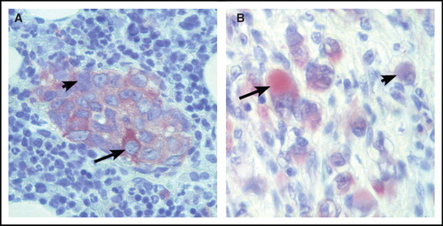 Figure 2. Human neuroblastoma specimens stained for neuron-specific enolase by immunohistochemistry. Sections of a neuroblastoma bone-marrow metastasis (A) and a ganglioneuroma specimen (B), respectively, stained for neuron-specific enolase (ENO2) expression. Note that tumor cells differ considerably in neuron-specific enolase levels, both at a more immature (panel A) and at a differentiated (panel B) stage. Arrows show enolase-positive and arrow-heads show enolase-negative tumor cells.