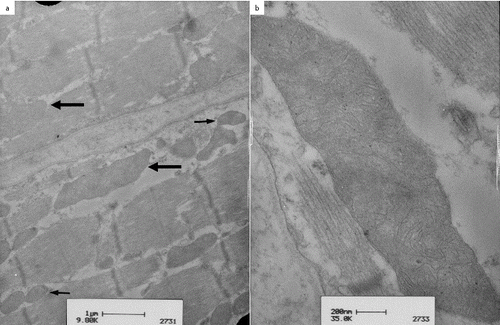 Figure 3. Transmission electron microscopy of the vastus lateralis muscle in patient 3, an eight-year-old Hanoverian mare: simultaneous presence of mitochondria of normal size and shape (a, small arrows) and large mitochondria (a, thick arrow) were seen. The right picture shows a detailed view of an extremely large mitochondrion with complex branching cristae (b).