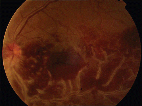 FIGURE 1  Fundus photography of the left eye at the beginning. Note the typical frosted branch angiitis appearance and premacular hemorrhage.