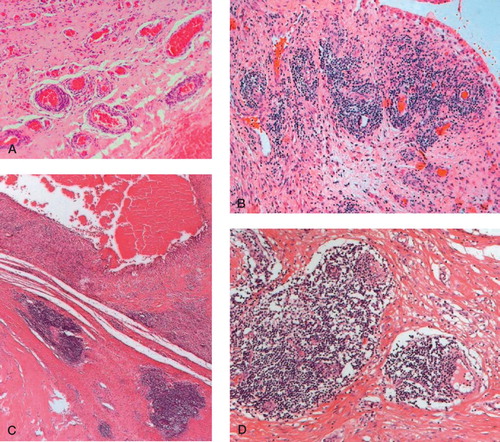 Figure 5. Perivasal accumulated lymphocytic infiltrates (H&E-stained sections). A. “Many” perivascular lymphocytic infiltrates (magnification 100×). B. “Abundant” perivascular lymphocytic infiltrates; few lymphocytic follicles without germinal centers (magnification 100×). C. and D. “Excessive” lymphoplasma cellular infiltration; lymphocytic follicles with formation of germinal centers in the intermediate vascular layer (magnification 25× (C) and 100× (D)).