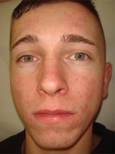 Figure 1B Acne treatment by capryloyl salicylic acid peel (22-year-old male) after treatment. Reduction of large inflammatory cysts two weeks after a single treatment with 10% capryloyl salicylic acid.
