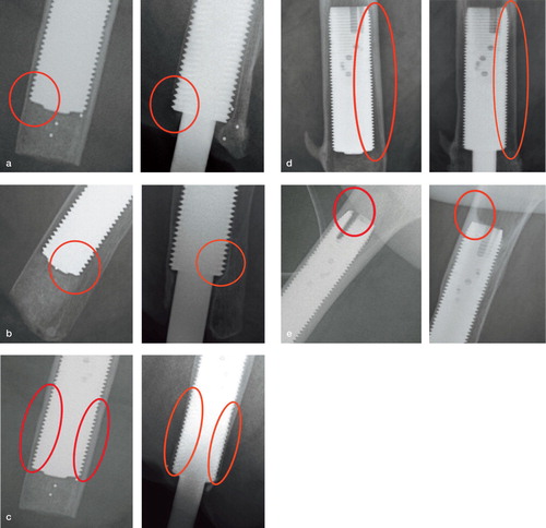 Figure 6. Distal bone resorption: zones A–D. Endosteal resorption: zones 1–12. Cortical thinning: zones 1–12. Cancellization: zones A–D and 1–12. Trabecular streaming or buttressing: zones 1, 6, 7, and 12. The stage-1 postoperative film shows the bone immediately following implantation of the device. Each 2-year film shows an example of distal bone resorption (panel a), endosteal resorption (b), cortical thinning (c), cancellization (d), and trabecular streaming or buttressing (e).