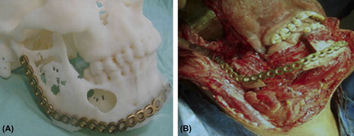 Figure 8. (A) Precontoured mandibular reconstruction plate placing over the right mandible with ameloblastoma, (B) Reconstruction plate bridging the gap following tumor resection. Adapted from reference (Citation15) with permission of Oral Surgery, Oral Medicine, Oral Pathology, Oral Radiology, and Endodontology, Elsevier, Copyright 2009.