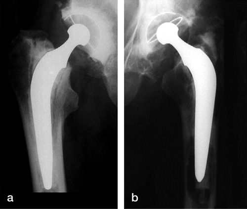 Figure 2. Radiograph showing gross loosening of Harvard femoral stem after 7 years in a patient with bilateral hip arthroplasty (a: Charnley stem, asymptomatic; b: Harvard stem, showing osteolysis and loosening).