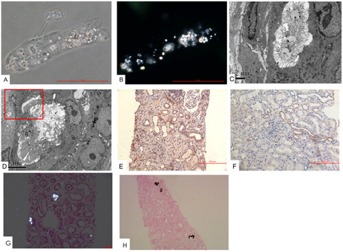 Figure 2. CaOx crystal cast and intrarenal depositions. Immunohistochemistry staining showed the expression of SLC26A6 transporter in (A and B) urinary sediments of a cast containing CaOx crystals. (C and D) Intraluminal and intracellular CaOx crystals (original magnification, ×5000). (E) Tubular expression of SLC26A6 transporter in a patient with severe oxalosis and (F) another patient with minimal change disease as the control (original magnification, ×200). (G) CaOx crystals under polarized microscopy (original magnification, ×200). (H) von Kossa staining showed calcium-containing crystals.