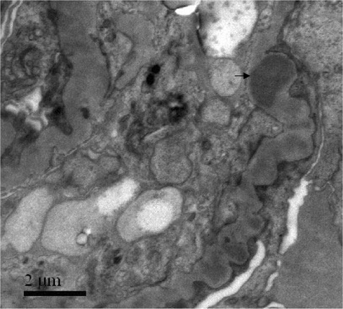 Figure 6. Electron-dense deposits in GBM and mesangium were seen by electron microscopy (arrowheads).