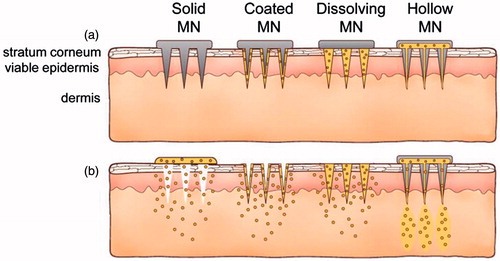 Figure 2. Methods of drug delivery to the skin using different MAs. Microneedles are first applied to the skin (a) and then used for drug delivery (b). Solid microneedle are used as a pretreatment, after which drug can diffuse through residual holes in skin from a topical formulation (solid MA). After insertion of drug-coated microneedles into the skin, the drug coating dissolves off the microneedles in the aqueous environment of the skin (coated MA). Drug-loaded microneedles are made of water-soluble or biodegradable materials encapsulating drug that is released in the skin upon microneedle dissolution (dissolving MN). Hollow microneedles are used to inject liquid formulations into the skin (hollow MA). Reprinted with permission from Butler (Citation2015).