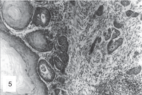 Figure 5.  Histological section of the forestomach of a mouse treated with the high dose of folpet. Note squamous cell carcinoma infiltrating the wall (H&E, ×200). (Reproduced by permission from A. Nyska et al., Induction of gastrointestinal tumors in mice fed the fungicide folpet: possible mechanisms. 1990. Jpn J Cancer Res 81:545–549.)