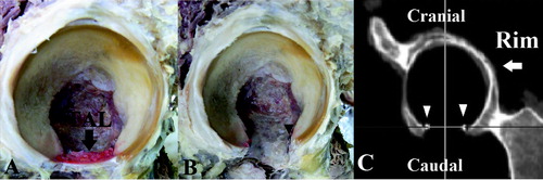 Figure 2. Verification of the TAL alignment measurement method. We verified the measurement method using cadaveric hips. A. The TAL and acetabulum were exposed. B. The beads were attached at the anterior and posterior insertion of the TAL. C. CT images before and after attachment of the beads on the posteroinferior and anteroinferior edges of the acetabular rim were obtained. We compared the anteversion of the line between the bony points on the first CT and the line between the beads on the second CT.