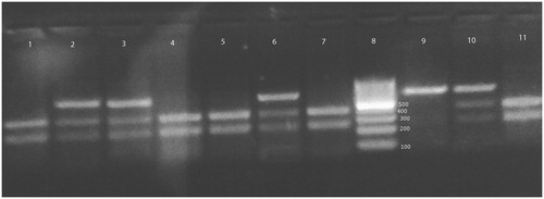 Figure 3. XRCC1 399 genotypes on ethidium bromide stained 3% agarose gel. Lanes 1, 4, 5, 7 and 11 are homozygous Arg/Arg genotype. Lanes 2, 3, 6 and 10 are heterozygous Arg/Gln genotype. Lane 9 is homozygous Gln/Gln genotype. Lane 8 is 100 bp ladder.