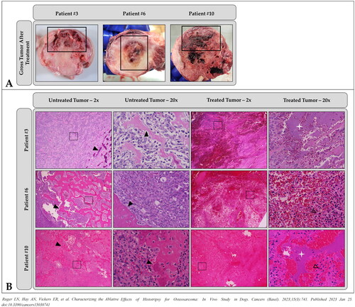 Figure 3. Representative images demonstrating histotripsy ablation in OS. (A) gross pathology and (B) low- (2×) and high-magnification (20×) microscopic histology images comparing treated and untreated OS tumor regions. In all patients shown, histotripsy-treated regions of the tumor (thick black boxes in (a)) were characterized by hemorrhage, tissue softening, and/or necrosis. Sections from untreated areas of OS tumors showed dense proliferation of neoplastic osteoblasts variably surrounding the osteoid matrix (black arrowheads). in contrast, sections from treated tumors exhibited hemorrhage and necrosis, abundant cell death (empty arrowheads identify dead or dying cells), complete tissue obliteration with replacement basophilic slipping (white star), and/or matrix degeneration (not shown). (B) were taken from boxed regions in columns 1 and 3, respectively.