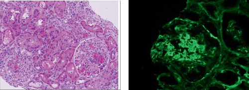Figure 1.  (a) Hematoxylin and eosin stain. Segmental endocapillary cellular proliferation (black arrow) and foci of tuft necrosis (white arrow). (b) Immunofluorescent microscopy. Focal glomerular C3 staining is evident in the mesangium.