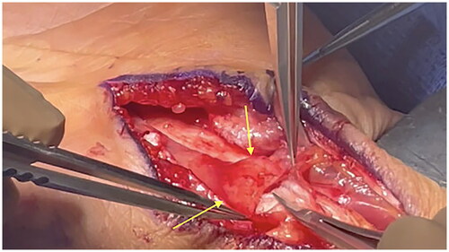 Figure 5. Intraoperative image of the left wrist. The median nerve is seen with an abnormal fusiform mass (yellow arrow). Micro-instrumentation is used to reveal the underlying mass to further assess for possible removal.