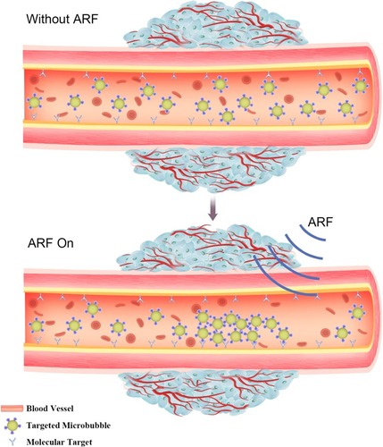 Figure 2 Evaluation of molecular targeted attachment of microbubbles using ARF. Without ARF, targeted microbubbles moving towards the direction of blood flow, thereby low adherence to the target. When ARF pulse exposure, the pulse pushes targeted microbubbles to the contralateral vascular wall, thus increasing targeted attachment of microbubbles.