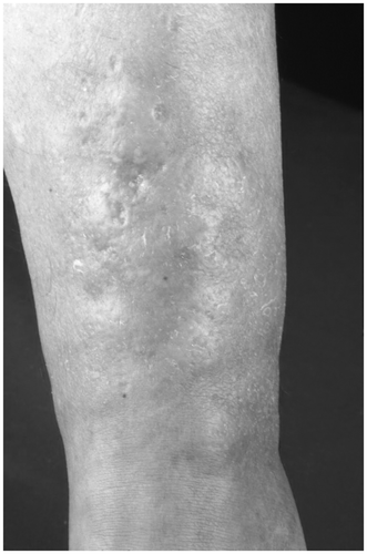 Figure 11. Myxedema. Pasty and voluminous skin; non-impressible not position-dependent edema.
