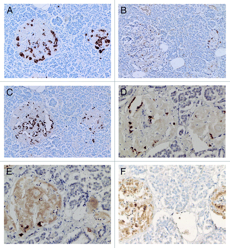 Figure 4. Diabetic islets Case 10, Islets occupied by amyloid deposits in 95% (A, B and C) and Islets occupied by amyloid deposits in > 99% (D, E and F). Islets occupied by amyloid deposits in 95%, A,B and C: Both large islet (Left) and medium-sized islet (Right) consisted of more than 95% amyloid deposits, within which β-cells with partly plump cytoplasm and α cells with dense small cytoplasm were located. IAPP-positive cells were weakly stained in the large islet but were moderately stained in the medium-sized islet. δ cells showed mostly small cytoplasm mixed with a few large cytoplasms. Islets occupied by amyloid deposits > 99%, D, E and F: Both large (Left) and medium-sized islet (Right) contained more than 99% amyloid deposits. Residual β-cells and δ-were minor cells and α-cells were major cells (D). IAPP immunostaing was performed using a 1: 400 diluted antibody solution, revealing moderately positive staining in amyloid deposits (E). In islets containing viable islet cells, residual islets cells with plump cytoplasm and amyloid deposits were stronger stained for IAPP than in Figure 3B. (A and D) Insulin; (B, E and F) IAPP by 1: 400 diluted solution; (C) Glucagon immunostained; Original magnification (A-C) X 320; (D-F) X 420.