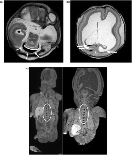 Figure 3. Case: Prenatal diagnosis of hydrocephalus, cerebellar hypoplasia and aqueductal stenosis. TOP at GA 27 weeks. PM MR shows hydrocephalus, rhombencephalosynapsis, CC dysgenesis, vertebral anomalies. CA shows hydrocephalus, rhombencephalosynapsis, CC dysgenesis. Vertebral anomalies are only depicted on PM MR, demonstrating superiority of PM MR over CA in this case. (a) T2-weighted image of the brain in the axial plane. Dilated right temporal horn of the lateral ventricle (black star). Black fluid surrounding the cerebellum (white arrows). The dentate nuclei appear fused (White circle) and there is no vermian structure visible (curved white line). (b) T2-weighted image of the brain in the axial plane. Severe ventriculomegaly with blood layering as a normal post mortem finding and destruction of the leaflets of the cavum septi pellucidi (thin black arrow). Furthermore, the normal layering of the cerebral mantle is seen with the germinative matrix, subventricular zone, subplate and cortical plate. (c) T1-weighted image of the body in the coronal plane. Abnormal ossification of a thoracic vertebral body (T11) in the lower half of the thoracic spine. (d) T1-weighted image of the body in the coronal plane. Abnormal ossification of two thoracic vertebral bodies (T1 and T4) in the upper half of the thoracic spine.