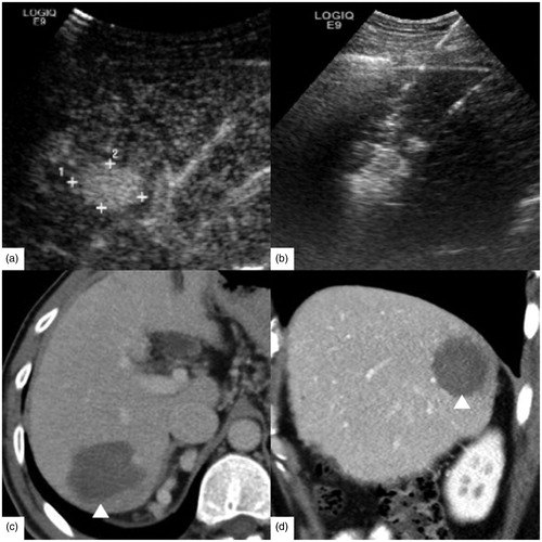Figure 2. A 54-year-old male had hepatocellular carcinoma with liver cirrhosis. α-AFP was 1848 ng/ml, CEA was 0.97 ng/ml, and CA-199 was 15.02 U/ml. (a) Contrast-enhanced ultrasound (CEUS) before radiofrequency ablation (RFA) showed the tumor size was 2.4 × 1.8 cm. (b) RFA was performed under ultrasound guidance with three 3 cm tip RF electrodes and the distance of electrodes was 1.3 cm. One month follow up contrast enhanced computed tomography on axial section (c) and sagittal section (d) showed the ablation zone (△) had no enhancement and the ablation zone was approximately sphere. The length, width and thickness of ablation zone was 4.0 cm, 3.5 cm, 3.2 cm, respectively.