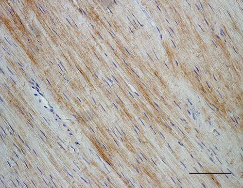 Figure 9. Microscopic longitudinal section of an injured tendon (B). Immunohistochemical localization of type III collagen. A marked immunostaining is present in an atypical, disorganized region. B refers to tendon ID (see Tables 1 and 2). Bar = 100 μm.