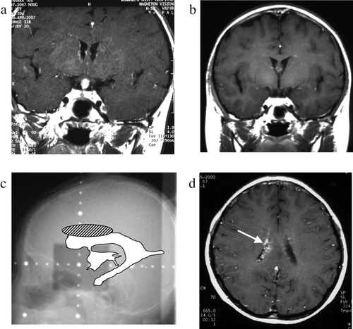 Figure 4.  Case 4, an 11-year-old boy. a: Pre-treatment MRI scan revealing a hypothalamic enhanced lesion. b: Post-treatment MRI scan shows complete disappearance of the hypothalamic mass. c: On this x-radiograph, the field of irradiation (gray area) and the ventricles (white area) on MRI scans are traced. The relapse site is identified by a hatched circle. d: MRI scan obtained at the time of tumor recurrence shows an enhanced lesion in the body of the right lateral ventricle (arrow).