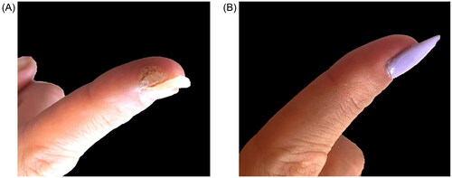 Figure 1. A single periungual wart on the finger of a patient (A) before and (B) 6 weeks after one injection of 0.2 mL of intralesional cidofovir (25 mg/mL).